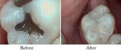 Dentist Mesa - Smile Gallery Before and After Case 10