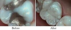 Dentist Mesa - Smile Gallery Before and After Case 11