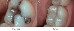 Dentist Mesa - Smile Gallery Before and After Case 14