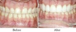 Dentist Mesa - Smile Gallery Before and After Case 2