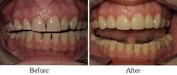 Dentist Mesa - Smile Gallery Before and After Case 3