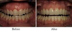 Dentist Mesa - Smile Gallery Before and After Case 4