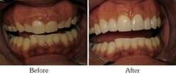 Dentist Mesa - Smile Gallery Before and After Case 5