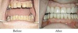 Dentist Mesa - Smile Gallery Before and After Case 7