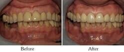 Dentist Mesa - Smile Gallery Before and After Case 8