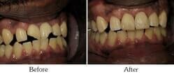 Dentist Mesa - Smile Gallery Before and After Case 9