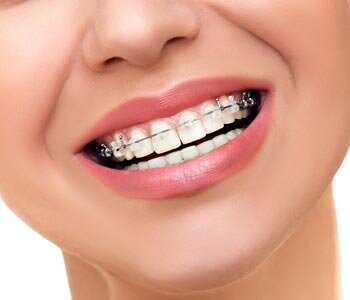 Best Orthodontics Treatment provider in Mesa, AZ area
